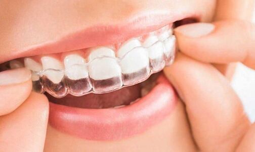 Comparación entre ortodoncia lingual e invisalign